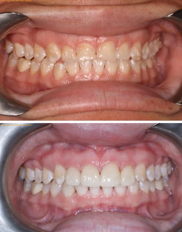 Smile Gallery - Complete Smile Restoration